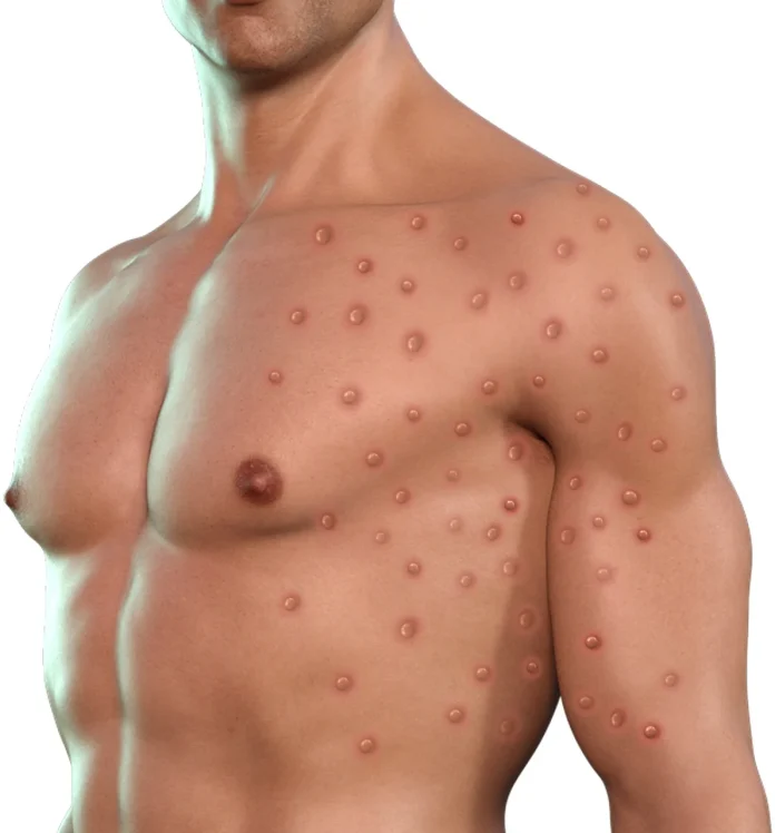monkeypox-7219694_1280